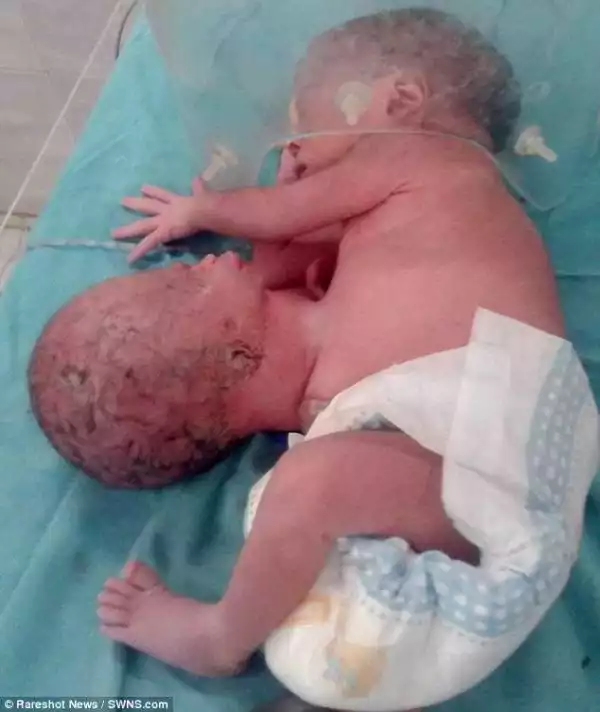 Baby Born In India With Additional Head Attached To Its Stomach. Photos